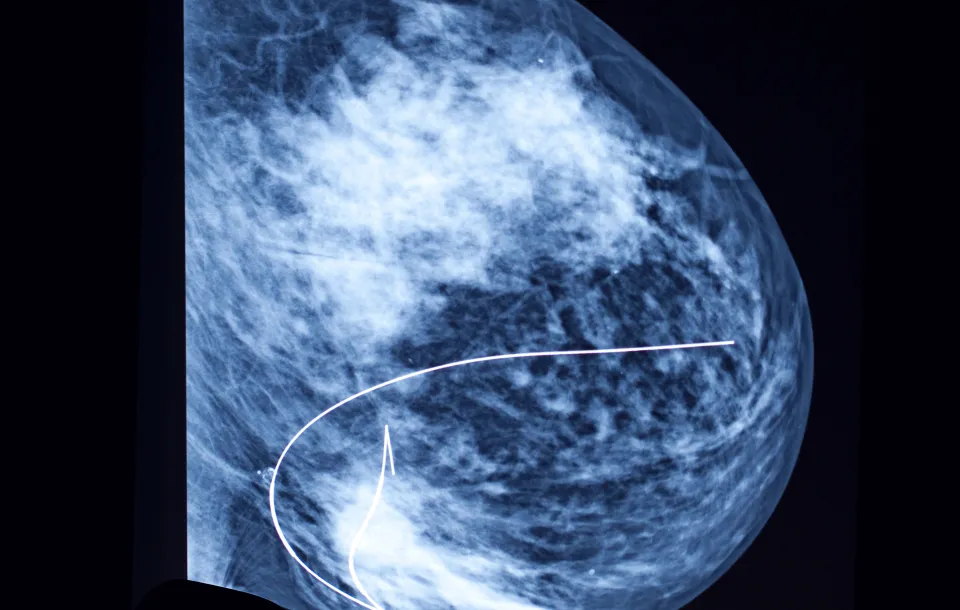 Breast Localizations for Technologist Webinar - MTMI