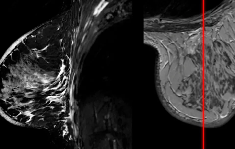 Breast MRI: Advancing Detection & Diagnosis in Women’s Imaging | 2 ASRT Category A CEs