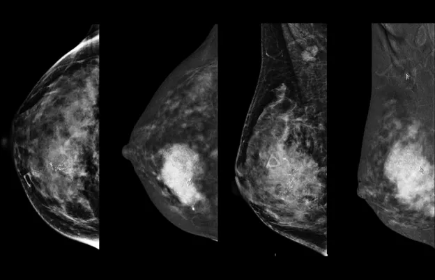 

            Contrast Enhanced Spectral Mammography
      