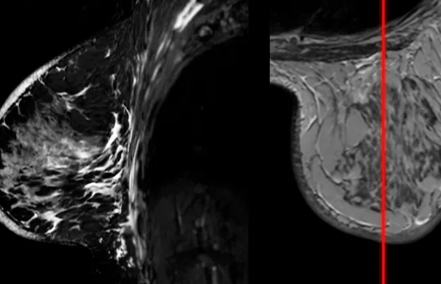 Breast MRI: Advancing Detection and Diagnosis in Women’s Imaging