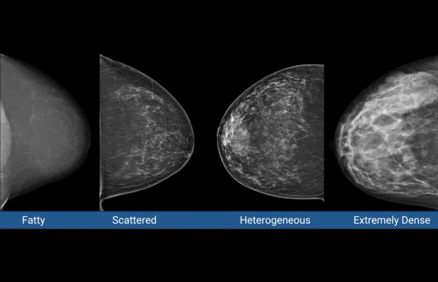 Understanding Dense Breasts: A Guide to Effective Imaging Choices