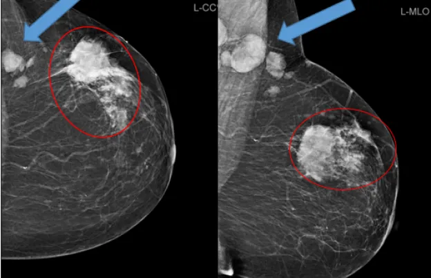 BI-RADS Categories & Modern Mammography