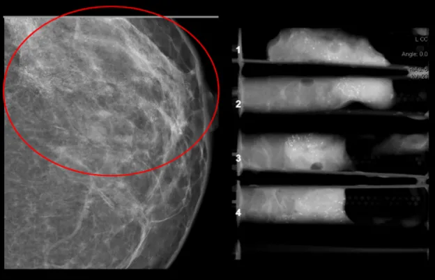 

            Stereotactic Breast Biopsy
      