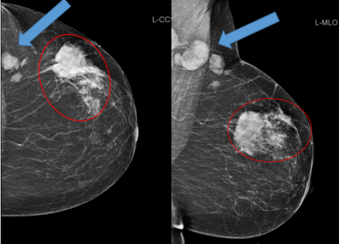 BI-RADS Categories Explained by Mammographers